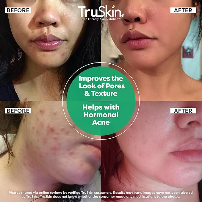 TruSkin Tea Tree Oil Acne Treatment for Face – Acne Serum – Improve the Appearance of Pores, Skin Tone for Smooth, Glowing Skin with Salicylic Acid, Vitamin C, Niacinamide & Retinol, 2 OZ